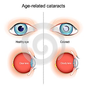 Cataracts. Age-related vision problems photo