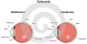 Cataracts