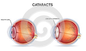 Cataracts photo