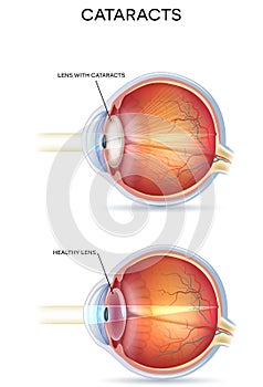 Cataracts photo