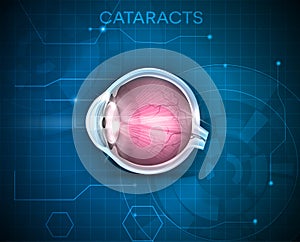 Cataracts, vision disorder photo