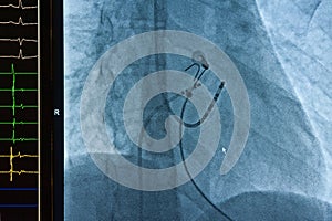 Catheter ablation for atrial fibrillation