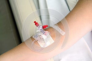 Catheter in the arm