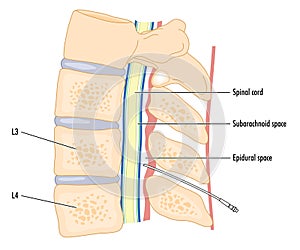 Catheter in epidural space photo
