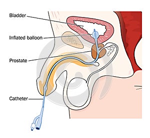 Catheter placed in male bladder photo