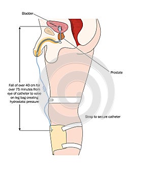 Catheter and urine bag