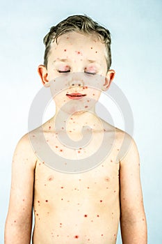 Caucasian boy with chickenpox infection, eyes closed, rash and blisters.