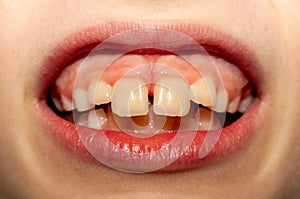 Caucasian European school boy showing his projecting upper front teeth