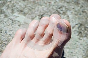 Caucasian foot with blue big toenail