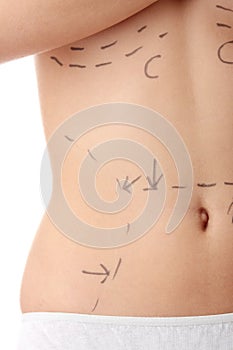 Caucasian woman's abdomen marked with lines