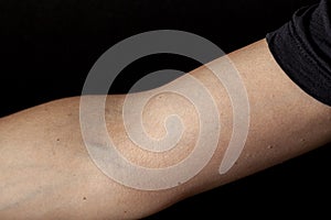 a caucasian woman's elbow section (ventral side) with forearm extended and arm at lateral rotation