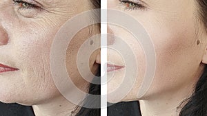 Caucasian woman wrinkles effect regenerationtreatment before and after correction procedures