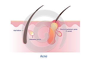 Cause of acne vector.