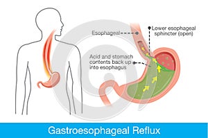 Cause of gastroesophageal reflux disease in human stomach