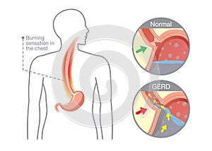 Cause of gastroesophageal reflux disease in human stomach