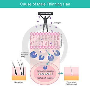 Cause of Male Thinning Hair. Illustration