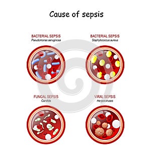 Cause of sepsis. Close-up of cross section of blood vessel with red blood cells, leukocytes, and  infection