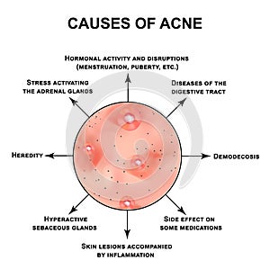 Causes of acne. Pustules, papules, comedones, blackheads, acne on the skin. Infographics. Vector illustration on