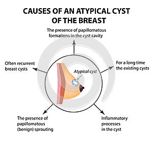 Causes of an atypical cyst in the mammary gland. World Breast Cancer Day. Tumor. Vector illustration on isolated background