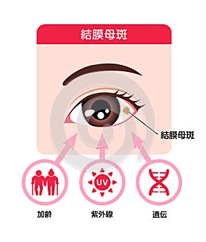 Causes of Conjunctival nevus vector illustration