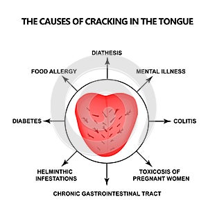 The causes of cracking in the tongue. Definition of a disease according to human tongue. Diagnostics by tongue. Tongue