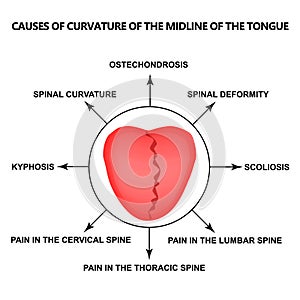 Causes of curvature of the midline of the tongue. Definition of a disease according to human tongue. Diagnostics by