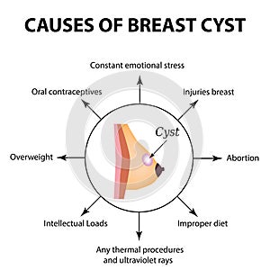 Causes of cyst in the mammary gland. World Breast Cancer Day. Tumor. Vector illustration on isolated background