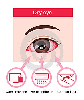 Causes of dry eye vector illustration