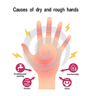 Causes of dry and rough hands  chapped hands  vector illustration
