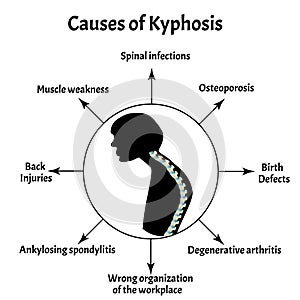 Causes of kyphosis. Spinal curvature, kyphosis, lordosis, scoliosis, arthrosis. Poor posture and slouching. Infographics photo
