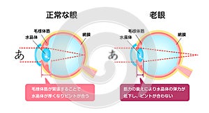 Causes and mechanism of cataract illustration