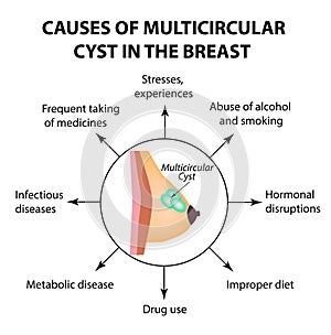 The causes of multicameral cyst. World Breast Cancer Day. Tumor. Vector illustration on isolated background