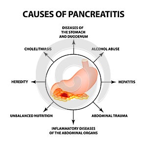 Causes of pancreatitis. The structure of the stomach and pancreas. Infographics. Vector illustration on isolated