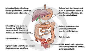 Causes of peritonitis