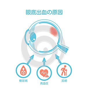 Causes of retinal hemorrhage. Vector illustration