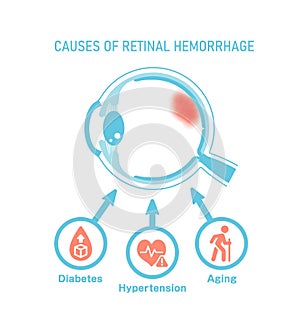 Causes of retinal hemorrhage. Vector illustration