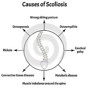 Causes of Scoliosis. Spinal curvature, kyphosis, lordosis of the neck, scoliosis, arthrosis. Improper posture and stoop