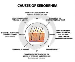 Causes of seborrhea. Seborrhea skin and hair. Dandruff, seborrheic dermatitis. Baldness, hair growth, baldness