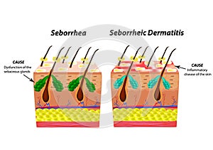 Causes Seborrhea skin and hair. Dandruff seborrheic dermatitis. Eczema. Dysfunction of the sebaceous glands