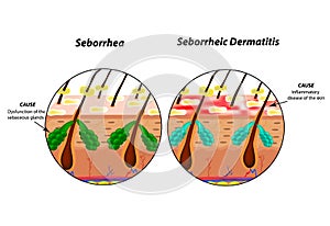 Causes Seborrhea skin and hair. Dandruff seborrheic dermatitis. Eczema. Dysfunction of the sebaceous glands