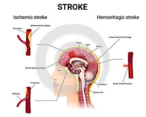 causes of stroke and the development of the disease