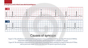 Causes of syncope