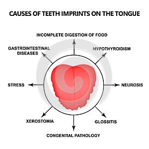 Causes of Teeth Imprints on the Tongue. Definition of a disease according to human tongue. Diagnostics by tongue. Tongue