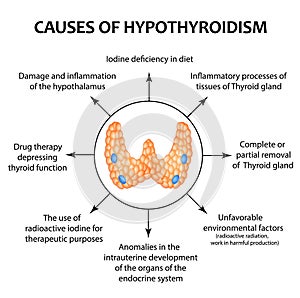 The causes of thyroid hypothyroidism. Infographics. Vector illustration on isolated background.