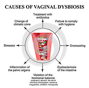 Causes of vaginal dysbiosis. Vaginitis. Candidiasis. Infographics.