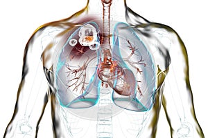 Cavitary tuberculosis, illustration