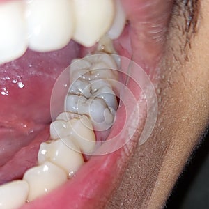 cavities in molars