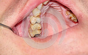 Cavities and old fillings in the upper teeth
