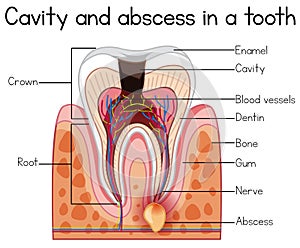 Cavity and Abscess in a Tooth photo