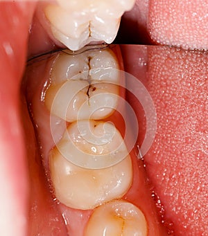 Cavity and teeth photo